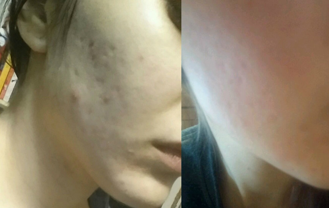 Aculift Derma Roller Before and After Acne Scars