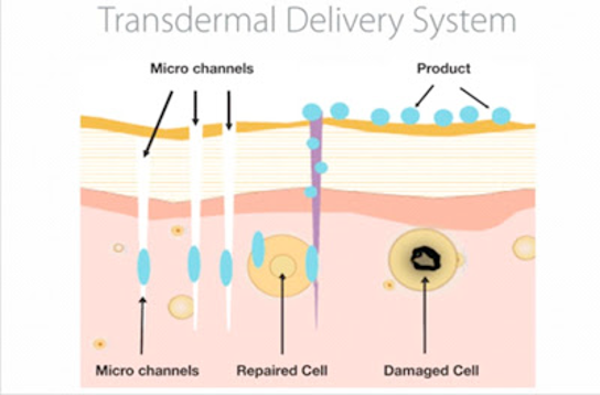 Microneedling creates channels for better skincare product absorption