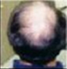 Hair Loss Before