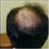 Scalp After Treatment