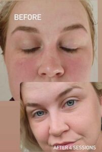 Rosacea treated with facial microneedling
