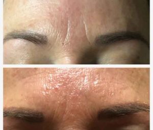 Brow wrinkles treated with facial microneedling
