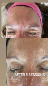 Brow wrinkles treated with facial microneedling