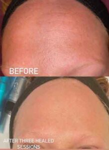 Forehead wrinkles treated with facial microneedling
