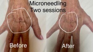 Aging hands treated with facial microneedling