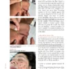 Chapter 4 excerpt from Treating the Face showing needling techniques