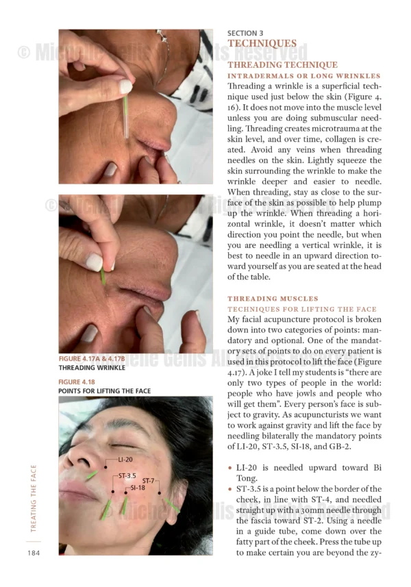 Chapter 4 excerpt from Treating the Face showing needling techniques