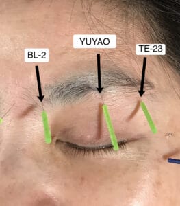 Acupuncture Location On Eyelid